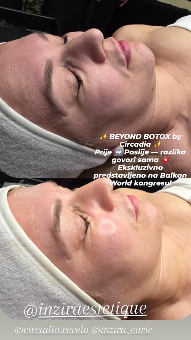 Beyond Botox by Circadia — prije i poslije